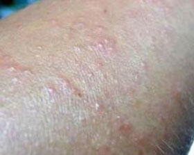 疥疮(scabies)是由于疥虫感染皮肤引起的一种皮肤病,本病传播迅速