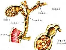 胆结石