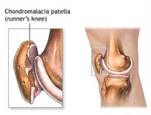 髌骨软化症