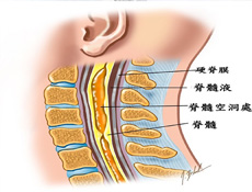 脊髓病变