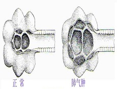 饮食疗法