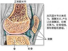 康复护理