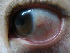 急性发作时,如症状不典型,或检查不够细致,有时可与急性虹膜睫状体炎