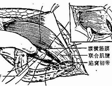 小腹疝气