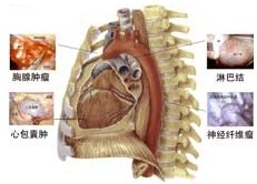 原发性纵隔肿瘤