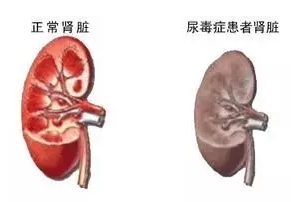 尿毒症患者透析能活多久？