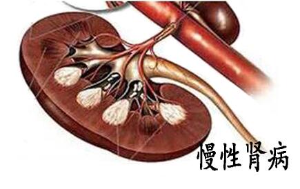 有尿蛋白就一定是肾病吗？尿蛋白高是怎么回事？
