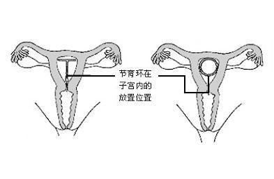 取环后短期内上环好吗