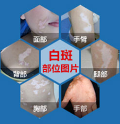 横沥哪里治疗白癜风好？背部白斑扩散怎么办