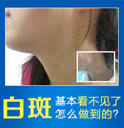 南城专业白癜风医院：白癜风怎么治疗才能省钱