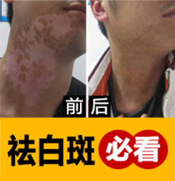 患了白癜风后患者能经常化妆吗