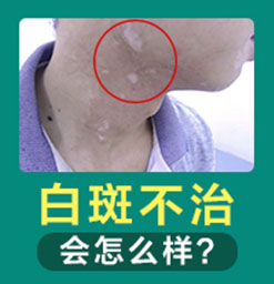 白癜风治疗后依旧没有效果是怎么回事