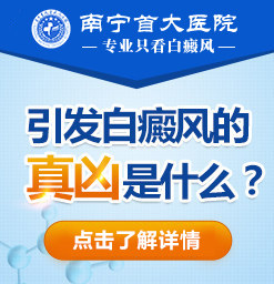 南宁白癜风皮肤治疗:白癜风如何治疗好得快?