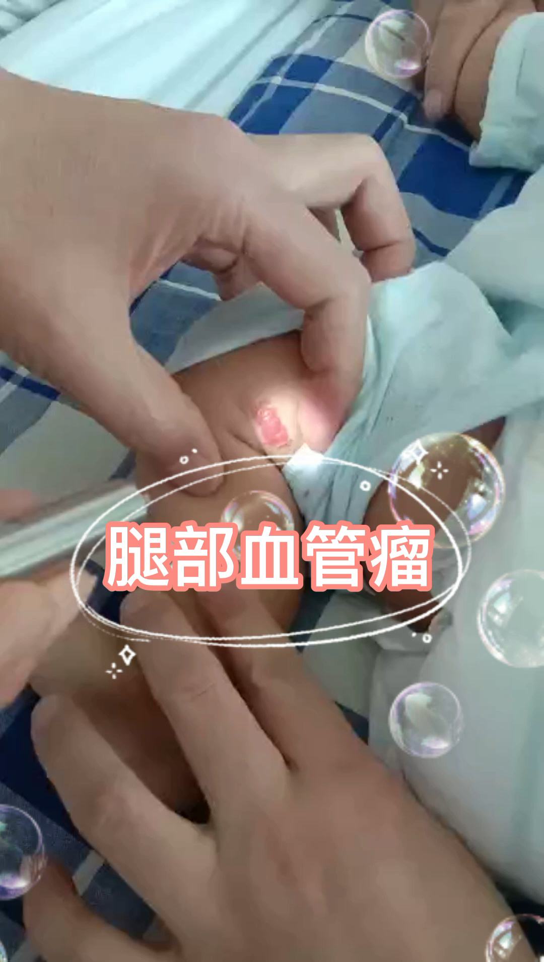 　婴儿腿部混合血管瘤的危害