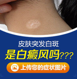 福建泉州治白癜风医院：白癜风不同的症状，需要明确诊断!